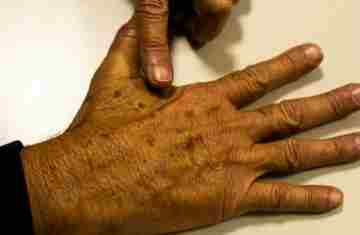  Desinformação sobre câncer de pele afeta diagnóstico, diz instituição 